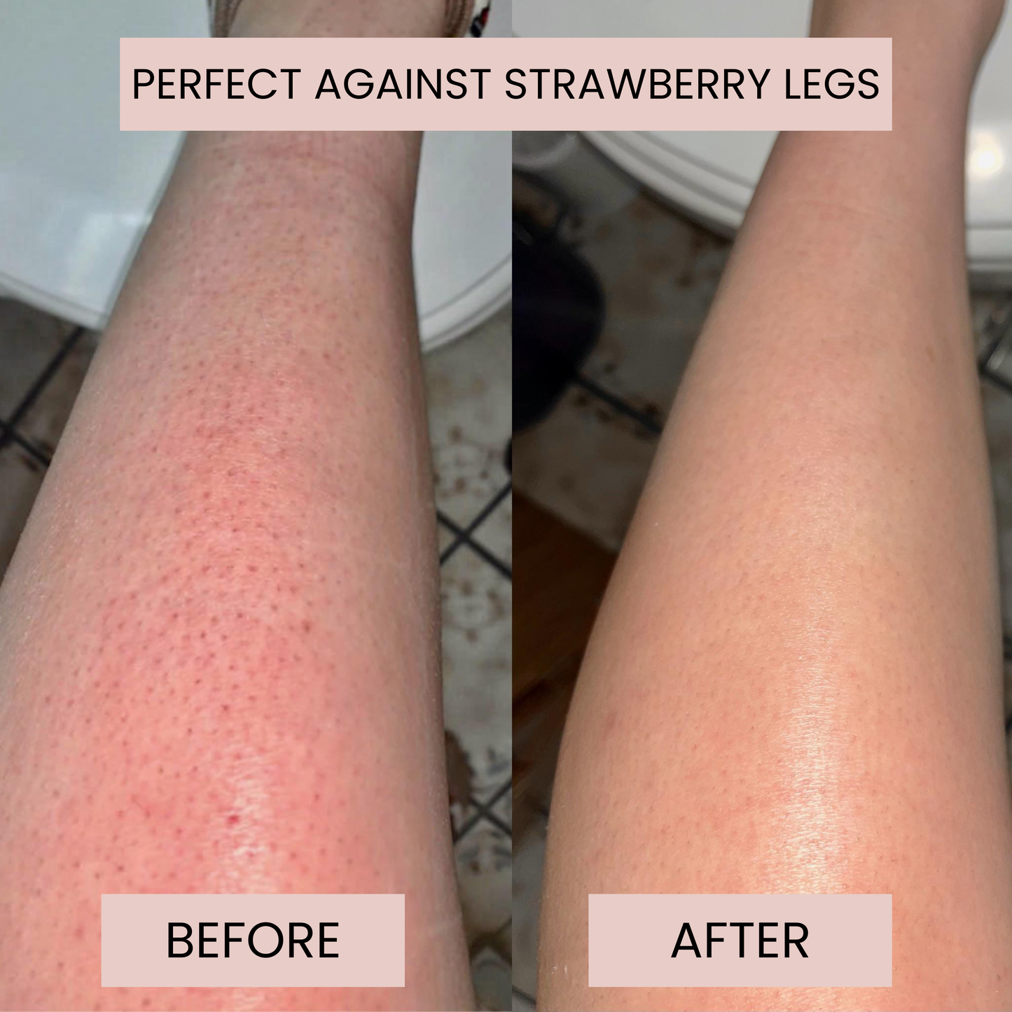 Smoothe™ KP Bump Eraser Cream