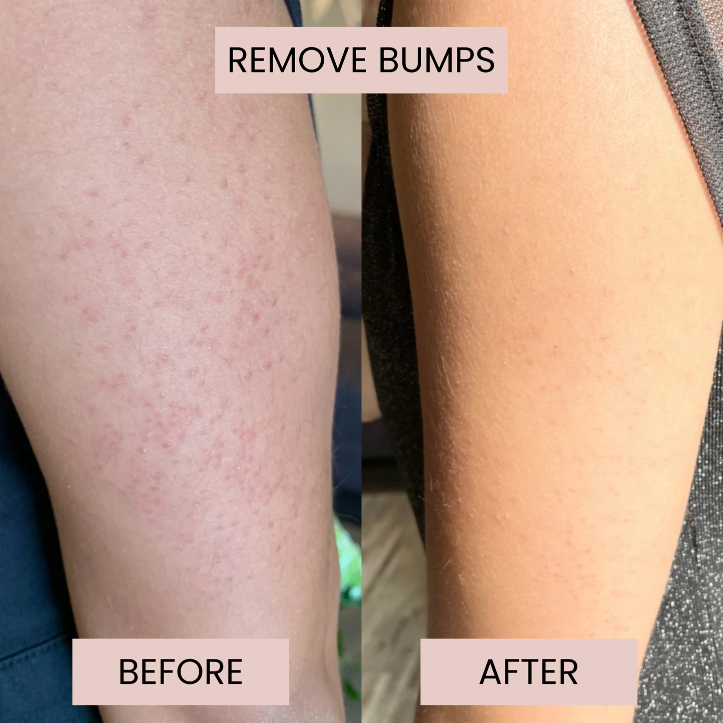 Smoothe™ KP Bump Eraser Cream
