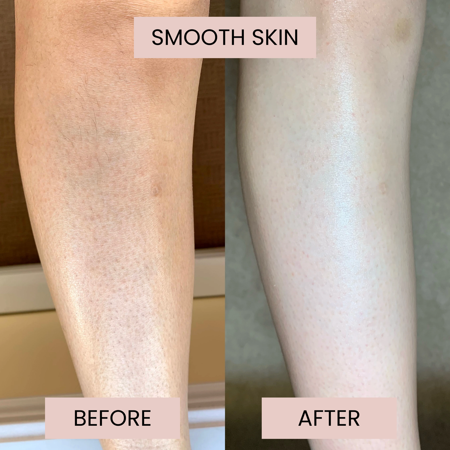 Smoothe™ KP Bump Eraser Cream
